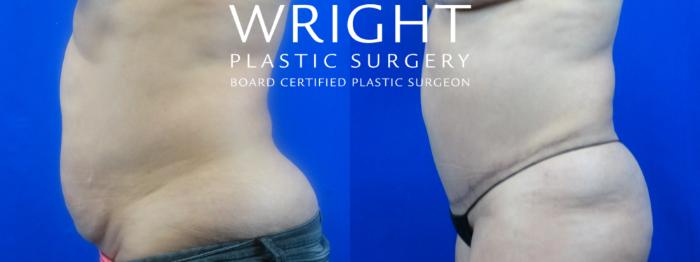 Before & After Tummy Tuck Case 32 Left Side View in Little Rock, Arkansas
