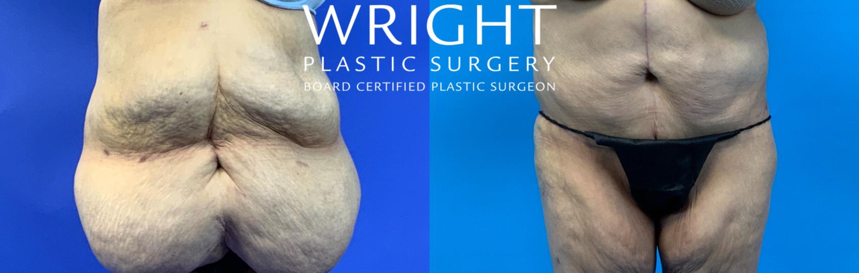 Before & After Tummy Tuck Case 322 Front View in Little Rock, Arkansas
