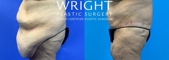 Before & After Tummy Tuck Case 322 Left Side View in Little Rock, Arkansas