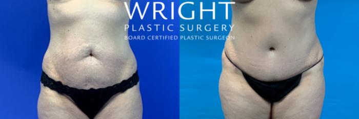 Before & After Tummy Tuck Case 338 Front View in Little Rock, Arkansas