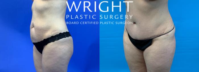 Before & After Tummy Tuck Case 338 Left Oblique View in Little Rock, Arkansas