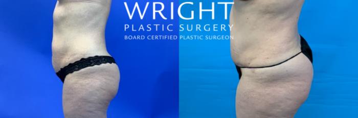 Before & After Tummy Tuck Case 338 Left Side View in Little Rock, Arkansas