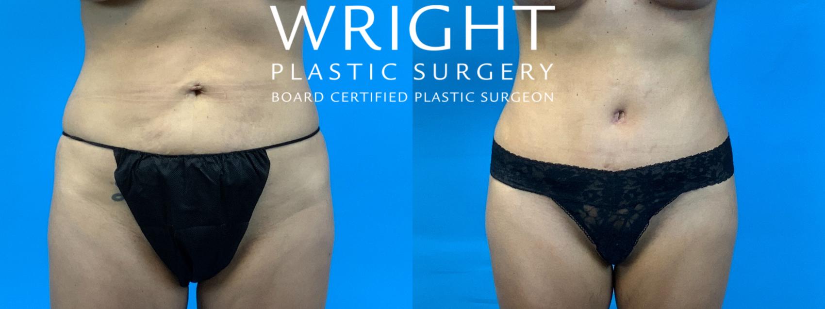 Before & After Tummy Tuck Case 340 Front View in Little Rock, Arkansas