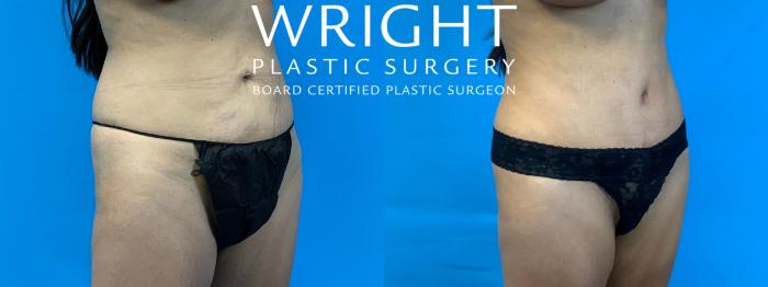 Before & After Tummy Tuck Case 340 Right Oblique View in Little Rock, Arkansas