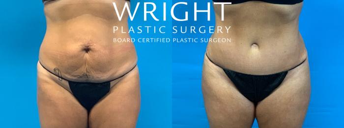 Before & After Tummy Tuck Case 341 Front View in Little Rock, Arkansas