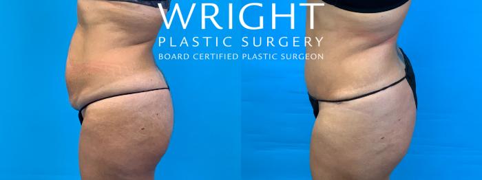 Before & After Tummy Tuck Case 341 Left Side View in Little Rock, Arkansas