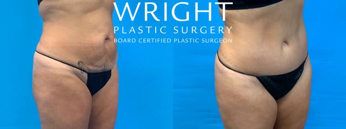 Before & After Tummy Tuck Case 341 Right Oblique View in Little Rock, Arkansas