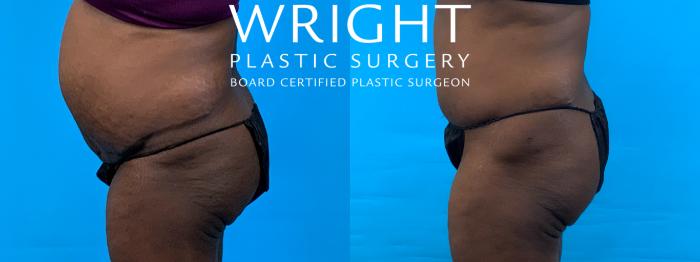 Before & After Tummy Tuck Case 343 Left Side View in Little Rock, Arkansas