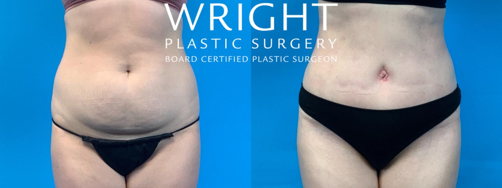 Before & After Tummy Tuck Case 347 Front View in Little Rock, Arkansas