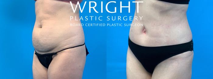 Before & After Tummy Tuck Case 347 Left Oblique View in Little Rock, Arkansas