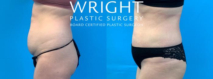 Before & After Tummy Tuck Case 347 Left Side View in Little Rock, Arkansas