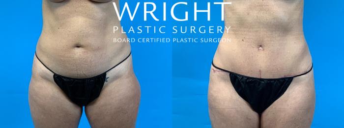 Before & After Liposuction Case 348 Front View in Little Rock, Arkansas