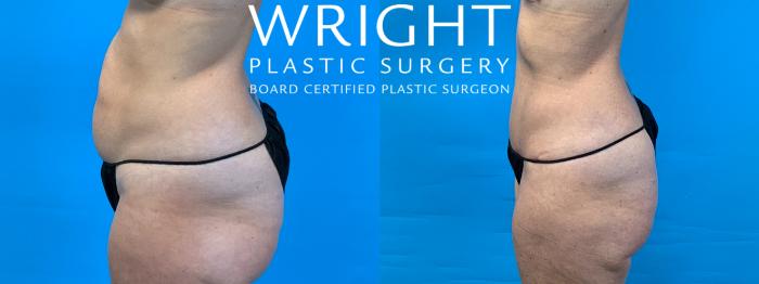 Before & After Tummy Tuck Case 348 Left Side View in Little Rock, Arkansas