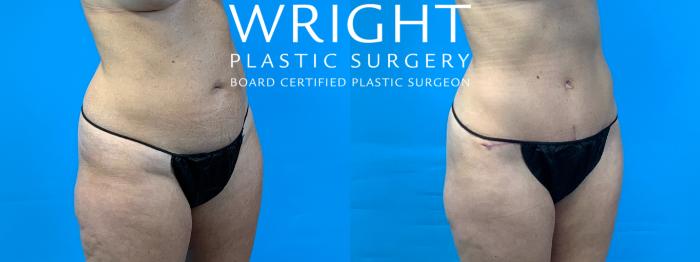 Before & After Tummy Tuck Case 348 Right Oblique View in Little Rock, Arkansas