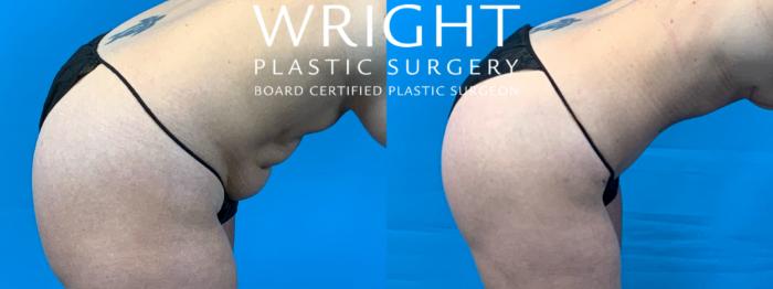 Before & After Liposuction Case 348 Right Side View in Little Rock, Arkansas