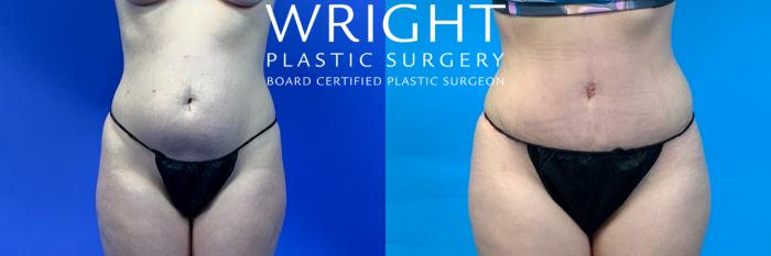 Before & After Tummy Tuck Case 350 Front View in Little Rock, Arkansas