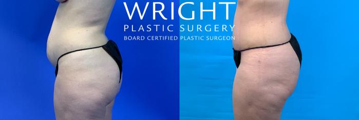 Before & After Tummy Tuck Case 350 Left Side View in Little Rock, Arkansas