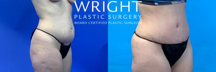 Before & After Tummy Tuck Case 350 Right Oblique View in Little Rock, Arkansas
