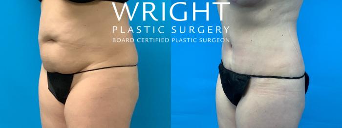 Before & After Tummy Tuck Case 352 Left Oblique View in Little Rock, Arkansas