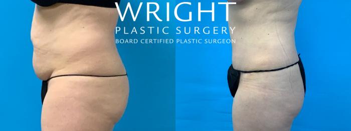 Before & After Tummy Tuck Case 352 Left Side View in Little Rock, Arkansas