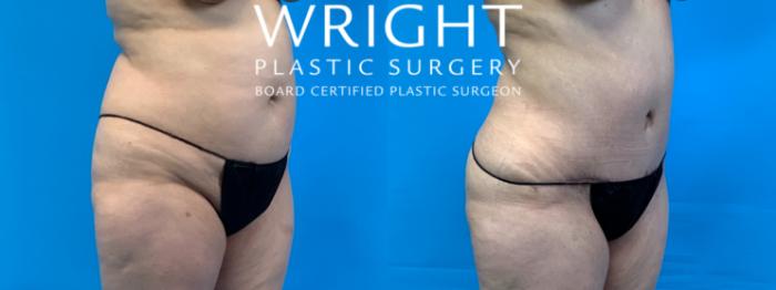 Before & After Tummy Tuck Case 357 Right Oblique View in Little Rock, Arkansas