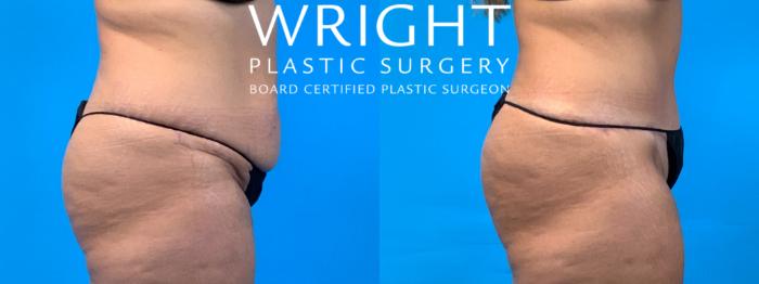Before & After Tummy Tuck Case 358 Right Side View in Little Rock, Arkansas