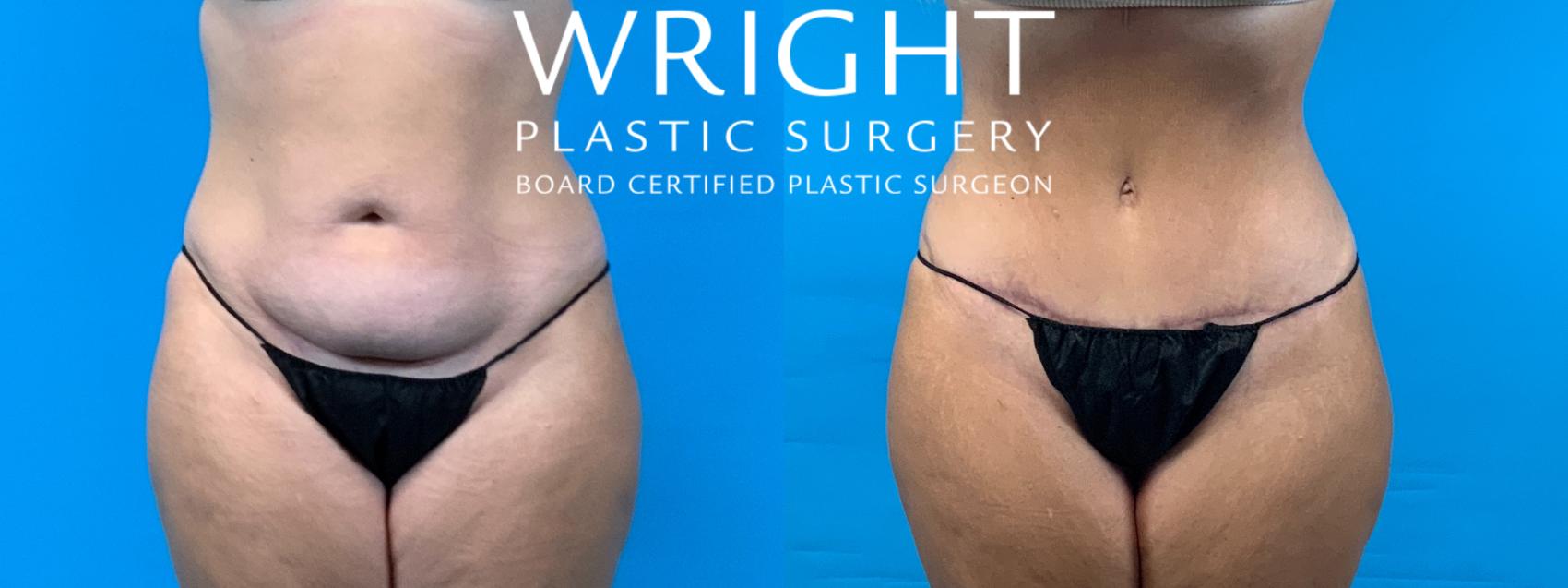 Before & After Tummy Tuck Case 359 Front View in Little Rock, Arkansas