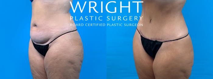 Before & After Tummy Tuck Case 359 Left Oblique View in Little Rock, Arkansas