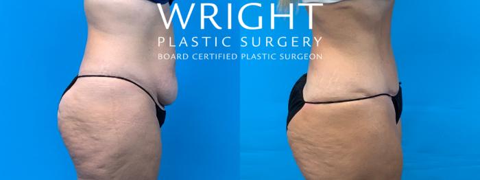 Before & After Tummy Tuck Case 359 Right Side View in Little Rock, Arkansas