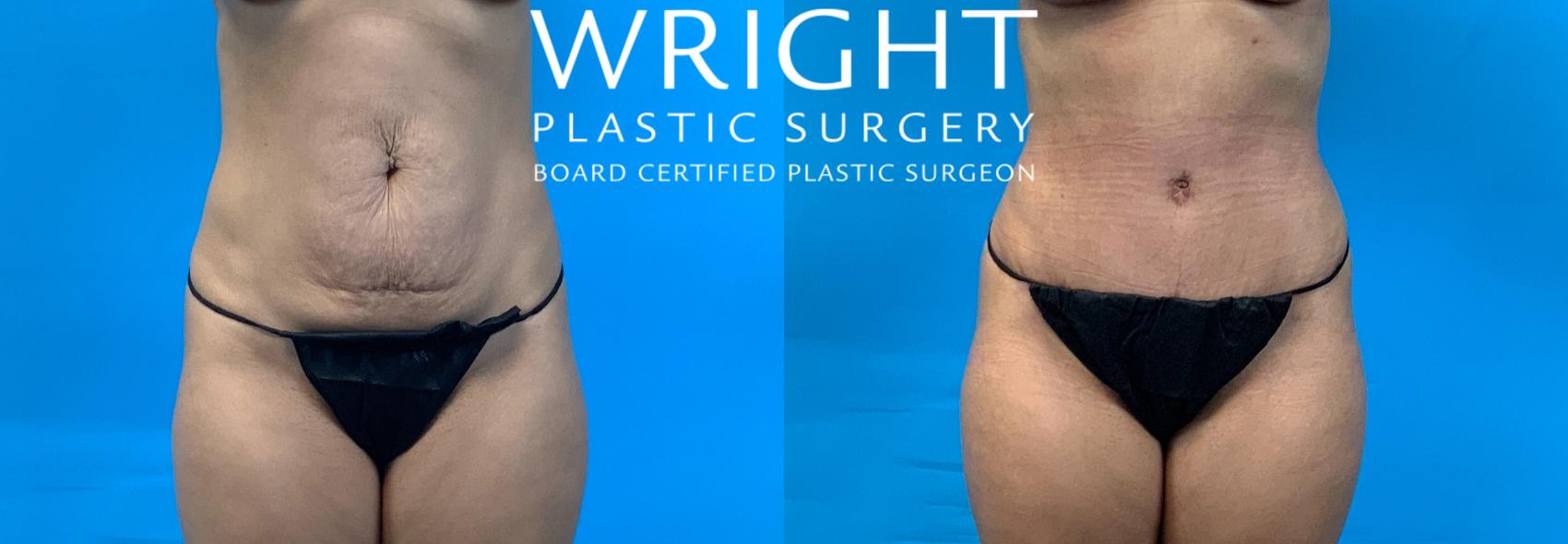 Before & After Tummy Tuck Case 363 Front View in Little Rock, Arkansas