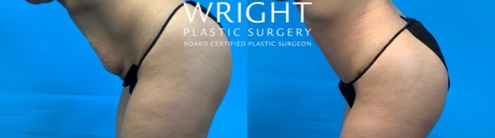 Before & After Tummy Tuck Case 363 Left Side View in Little Rock, Arkansas