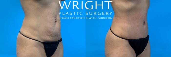 Before & After Tummy Tuck Case 363 Right Oblique View in Little Rock, Arkansas