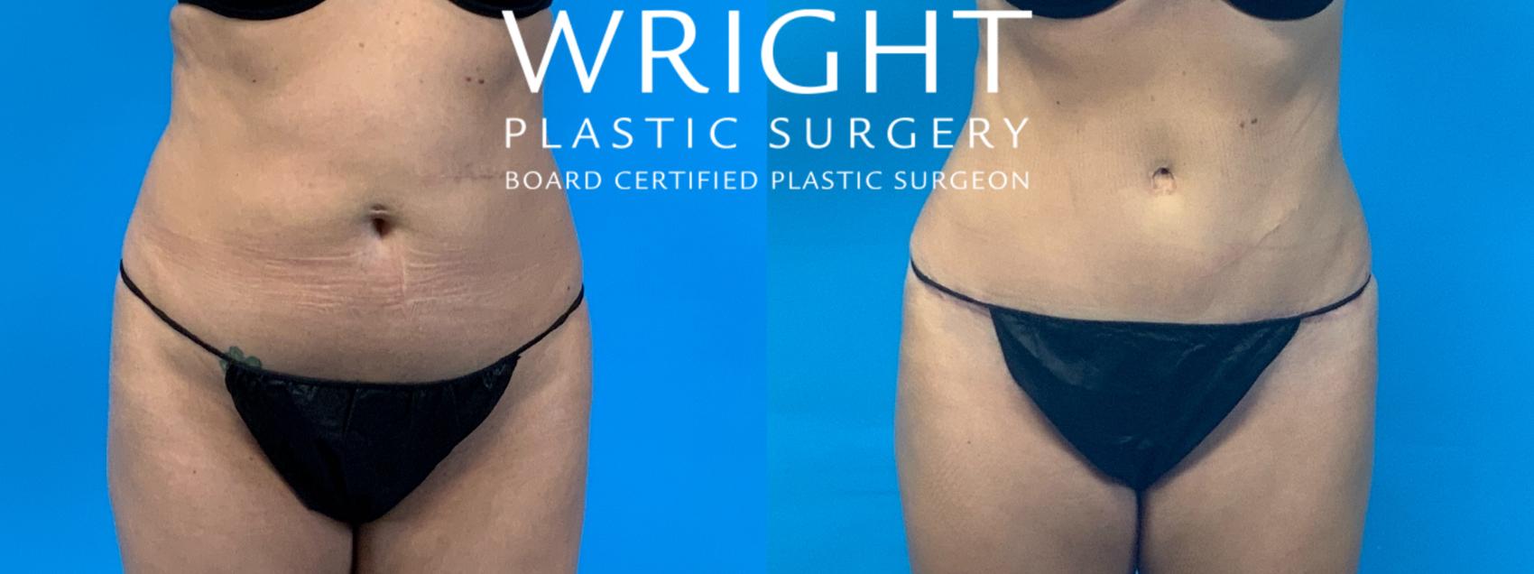 Before & After Tummy Tuck Case 385 Front View in Little Rock, Arkansas