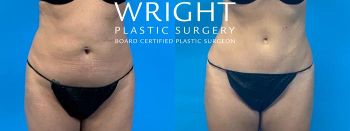 Before & After Liposuction Case 385 Front View in Little Rock, Arkansas