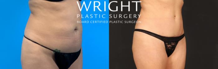 Before & After Tummy Tuck Case 385 Right Oblique View in Little Rock, Arkansas