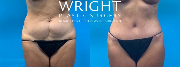 Before & After Tummy Tuck Case 387 Front View in Little Rock, Arkansas