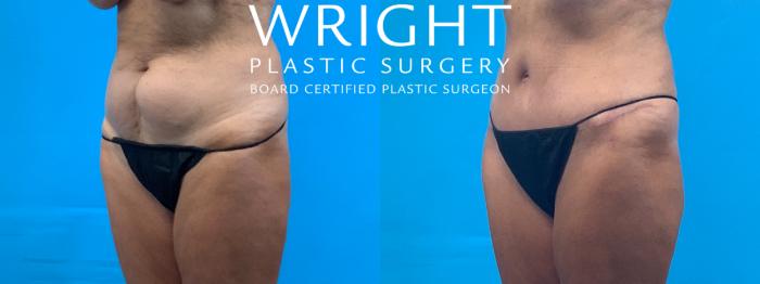 Before & After Tummy Tuck Case 387 Left Oblique View in Little Rock, Arkansas