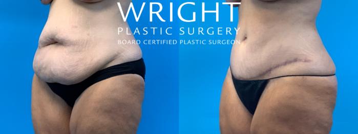 Before & After Tummy Tuck Case 396 Left Oblique View in Little Rock, Arkansas