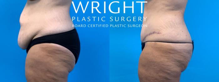 Before & After Tummy Tuck Case 396 Left Side View in Little Rock, Arkansas