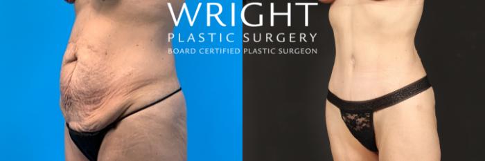 Before & After Liposuction Case 404 Left Oblique View in Little Rock, Arkansas
