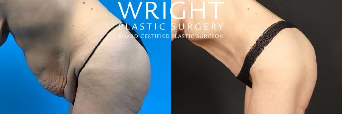Before & After Tummy Tuck Case 404 Left Side View in Little Rock, Arkansas