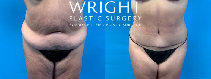 Before & After Tummy Tuck Case 405 Front View in Little Rock, Arkansas