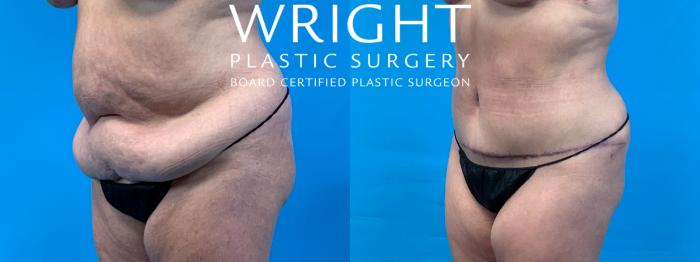 Before & After Tummy Tuck Case 405 Left Oblique View in Little Rock, Arkansas