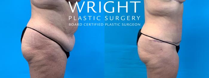 Before & After Liposuction Case 405 Right Side View in Little Rock, Arkansas