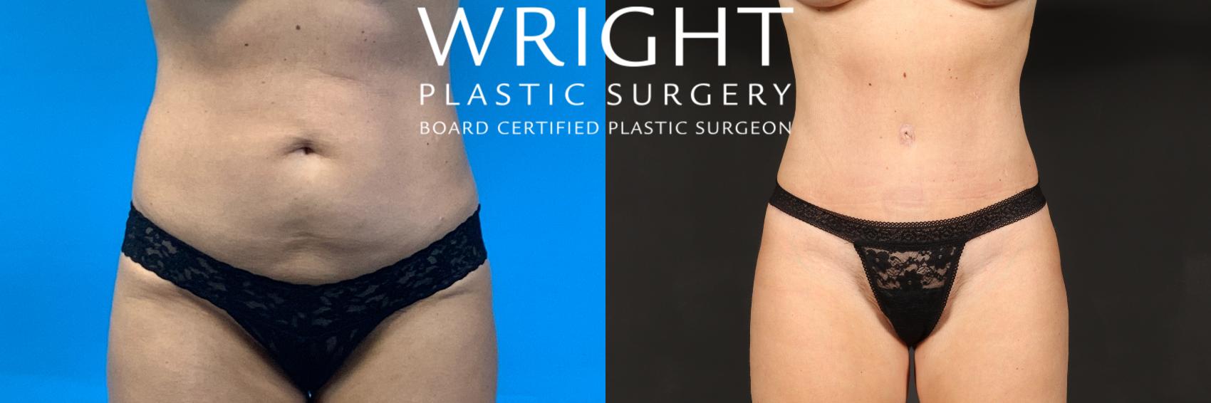 Before & After Tummy Tuck Case 409 Front View in Little Rock, Arkansas