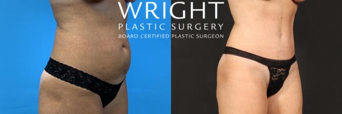Before & After Tummy Tuck Case 409 Right Oblique View in Little Rock, Arkansas