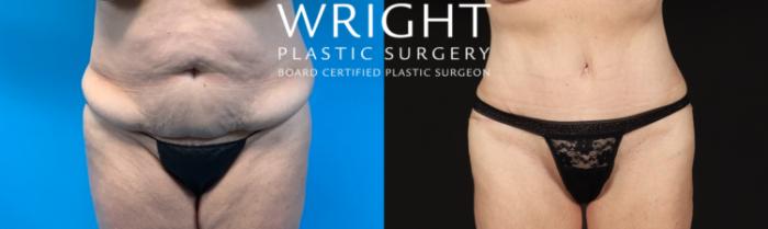 Before & After Tummy Tuck Case 416 Front View in Little Rock, Arkansas