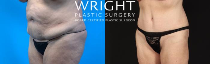 Before & After Liposuction Case 416 Left Oblique View in Little Rock, Arkansas