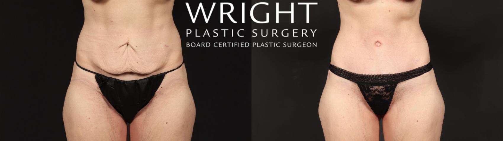 Before & After Tummy Tuck Case 429 Front View in Little Rock, Arkansas