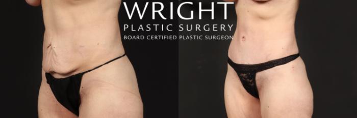 Before & After Tummy Tuck Case 429 Left Oblique View in Little Rock, Arkansas
